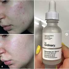 The Ordinary Niacinamide 10% + Zinc 1% 30ml Brightening Oil Control Serum